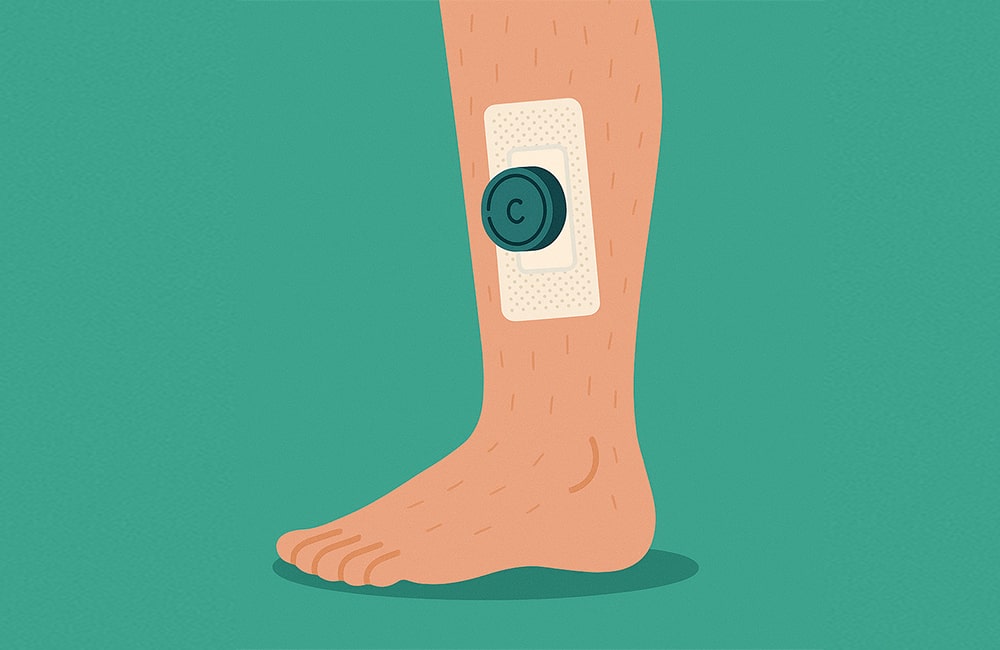 جهاز التثبيت الخارجي على الساق بعد عملية تطويل القامة