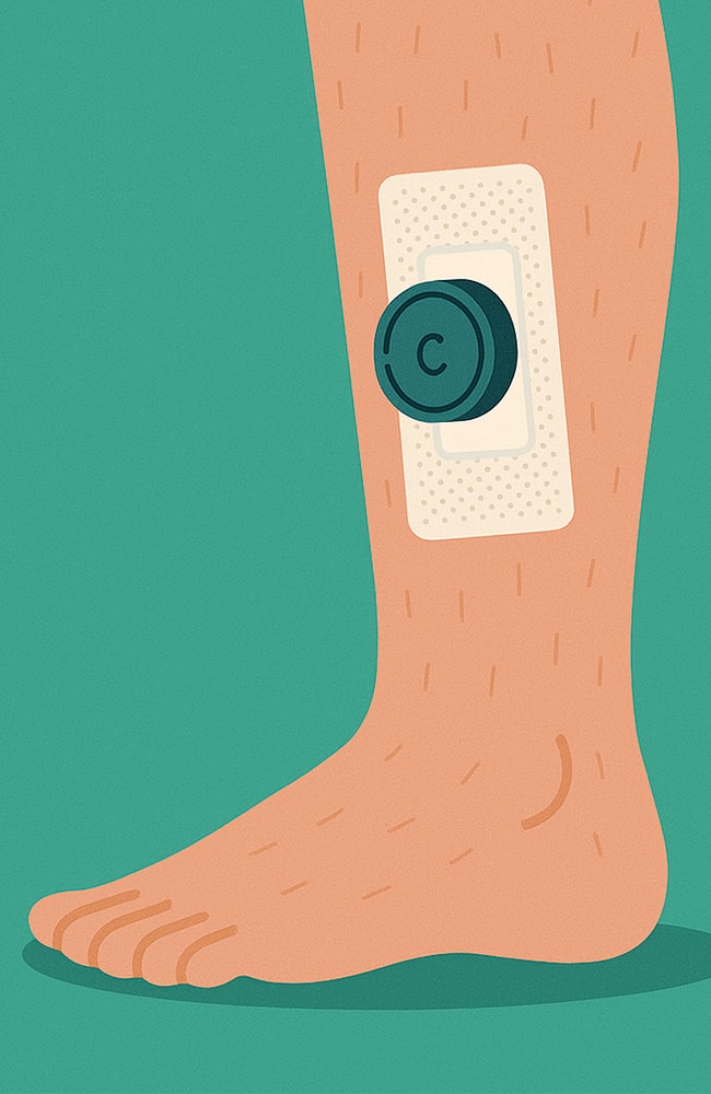 جهاز التثبيت الخارجي على الساق بعد عملية تطويل القامة