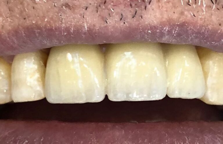 النتيجة النهائية لزراعة الأسنان: ابتسامة كاملة بتركيب التيجان الخزفية عالية الجودة.