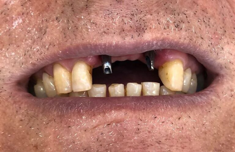 صورة لحالة فموية قبل التركيب النهائي للتاج تظهر الزرعات التيتانيومية جاهزة لاستقبال الدعامات.