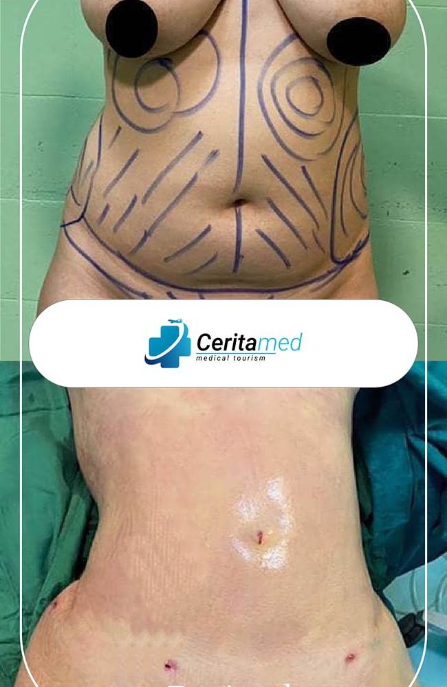 تخطيط نحت البطن والخصر ونتائجه النهائية