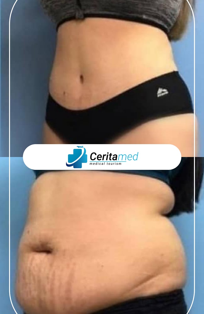 نحت الخصر والبطن - إطلالة جانبية قبل وبعد