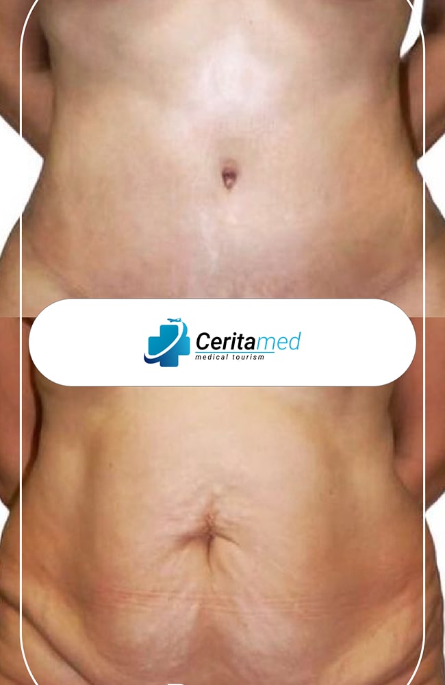 تسطيح البطن وشفط الدهون - مقارنة أمامية