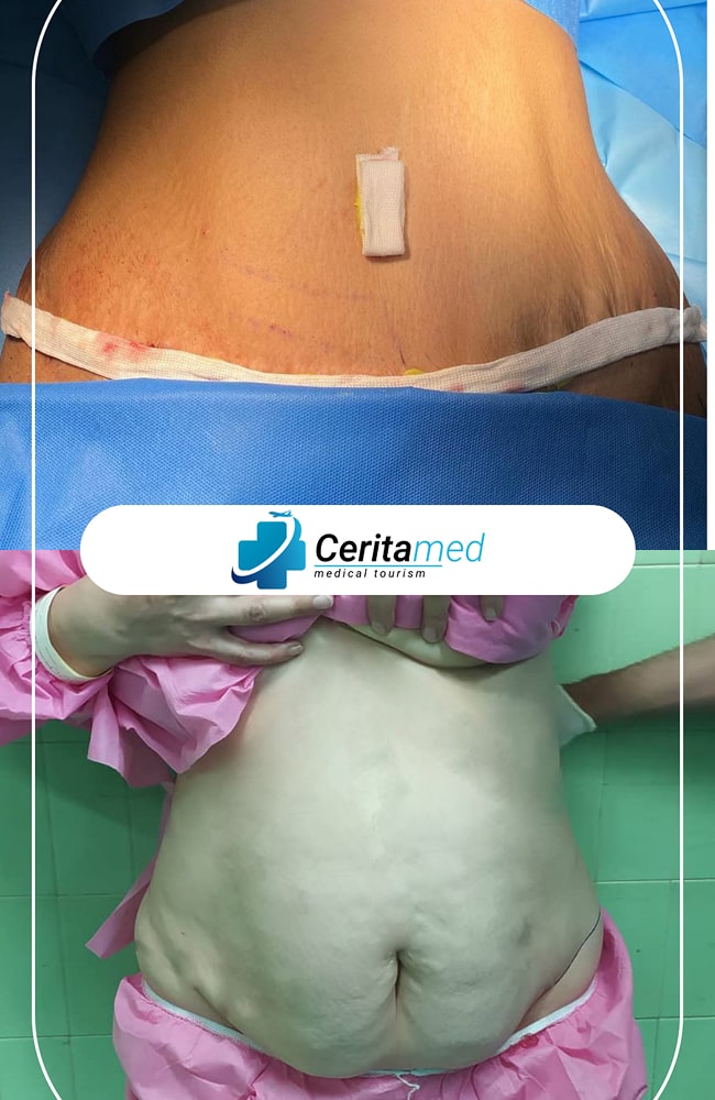 نتيجة شفط الدهون الفورية (قبل وبعد)