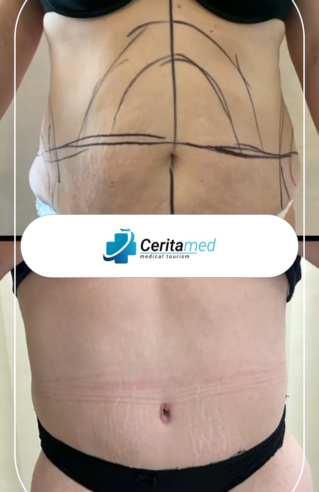 تخطيط نحت الجسم ونتائجه النهائية (قبل وبعد)