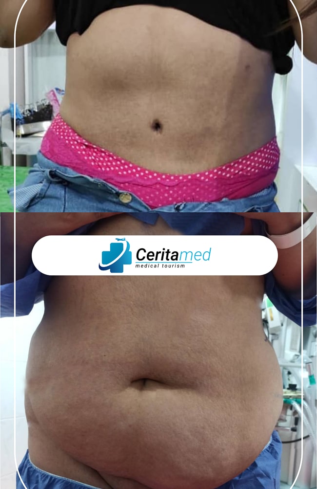 إزالة ترهلات الجلد (شد البطن) - صور قبل وبعد