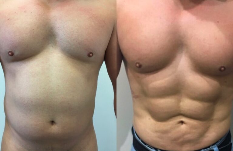نحت عضلات البطن للرجال (Six-Pack Abs) - قبل وبعد