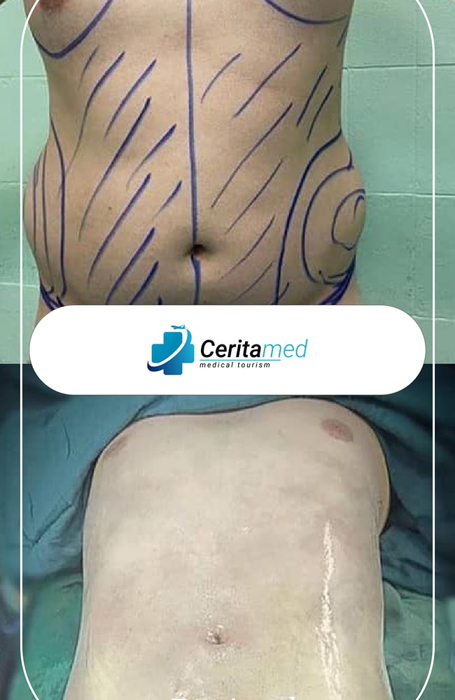 تخطيط نحت الجسم والنتائج - قبل وبعد