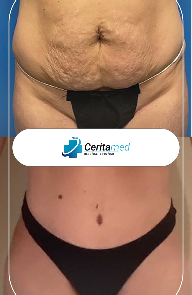 نتائج شد البطن للترهلات الشديدة - قبل وبعد