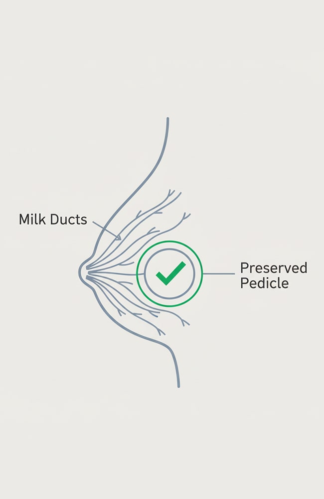 رسم تخطيطي يوضح الحفاظ على القنوات اللبنية والسويقة المغذية للحلمة في جراحة تصغير الثدي