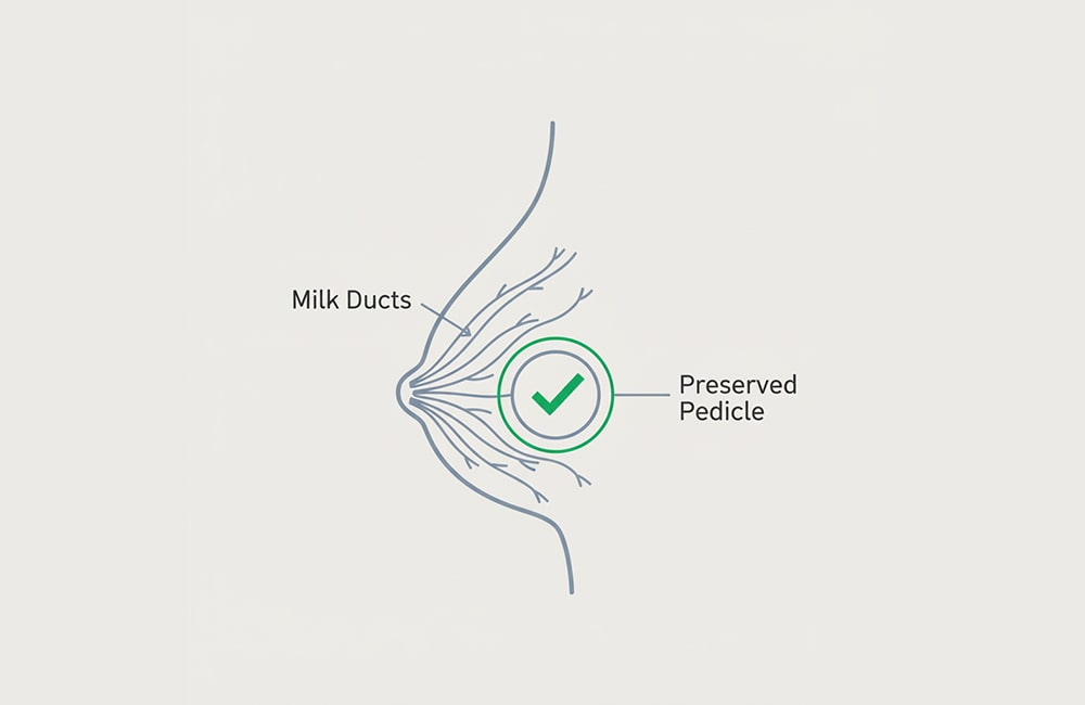 رسم تخطيطي يوضح الحفاظ على القنوات اللبنية والسويقة المغذية للحلمة في جراحة تصغير الثدي