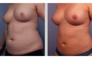 مقارنة قبل وبعد عملية تكبير الثدي بالدهون، تُظهر تحسينات في الحجم والامتلاء.