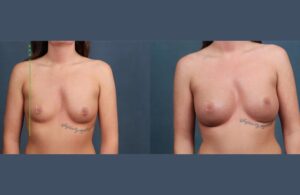 صورة تُظهر تحسن المظهر الجانبي للثدي بعد عملية حقن الدهون، من الجانب.
