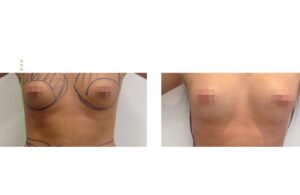 مقارنة أمامية تظهر نتائج عملية تكبير الثدي بالدهون الذاتية، بتحسين متناسق.