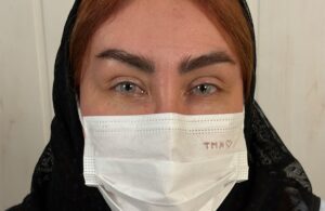 صورة تُظهر عيون المريضة بعد تغيير اللون بتقنية صبغة القرنية، مع تحول اللون إلى درجة رمادية فاتحة.