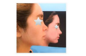 صورة جانبية تُقارن محيط الوجه قبل وبعد حقن الدهون الذاتية لتحسين البروز الجانبي.