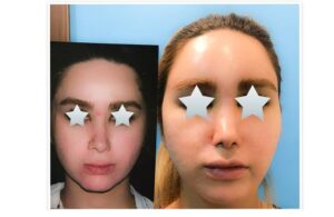 مقارنة أمامية تظهر نتائج حقن الدهون الذاتية لتحسين امتلاء الوجه وتناسقه.