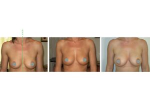 ثلاثة صور تُظهر مراحل تكبير الثدي بحقن الدهون، من التخطيط الأولي إلى النتيجة النهائية.