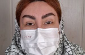 صورة مقربة للعين قبل إجراء صبغة القرنية، تُظهر اللون الأصلي البني الداكن للمريضة.