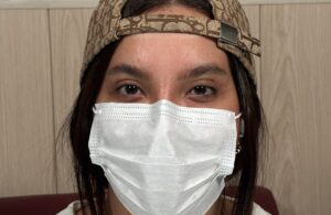 صورة مقربة للعين قبل العملية، تُظهر اللون الطبيعي الداكن والعين كاملة.