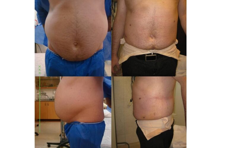 مقارنة أربعة مناظر مختلفة قبل وبعد عملية شفط الدهون، تُظهر التخلص من الدهون الزائدة في منطقة البطن والأجناب.