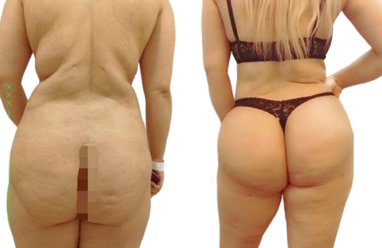 شفط الدهون من المؤخرة والظهر - قبل وبعد (من الخلف)