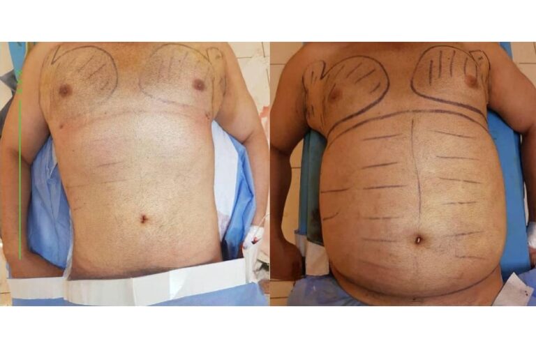 صورة تظهر علامات التخطيط الجراحي على منطقة البطن قبل عملية شفط الدهون، ومقارنة مع الحالة النهائية.