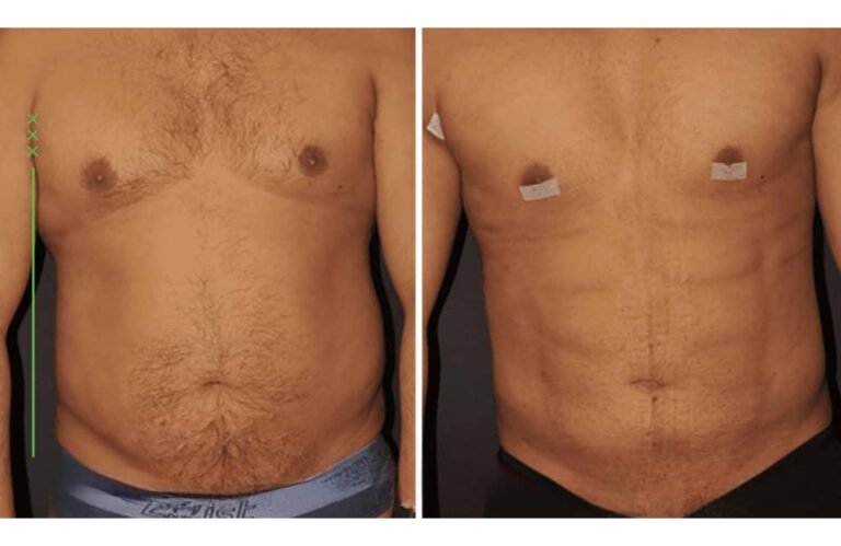 تحسن واضح في محيط البطن والخصر للرجال بعد عملية شفط الدهون، يُظهر بناء عضلات أكثر تحديداً.