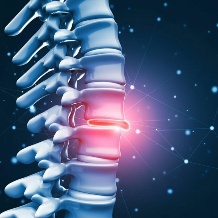 عملية جراحة الديسك القَطَني في إيران